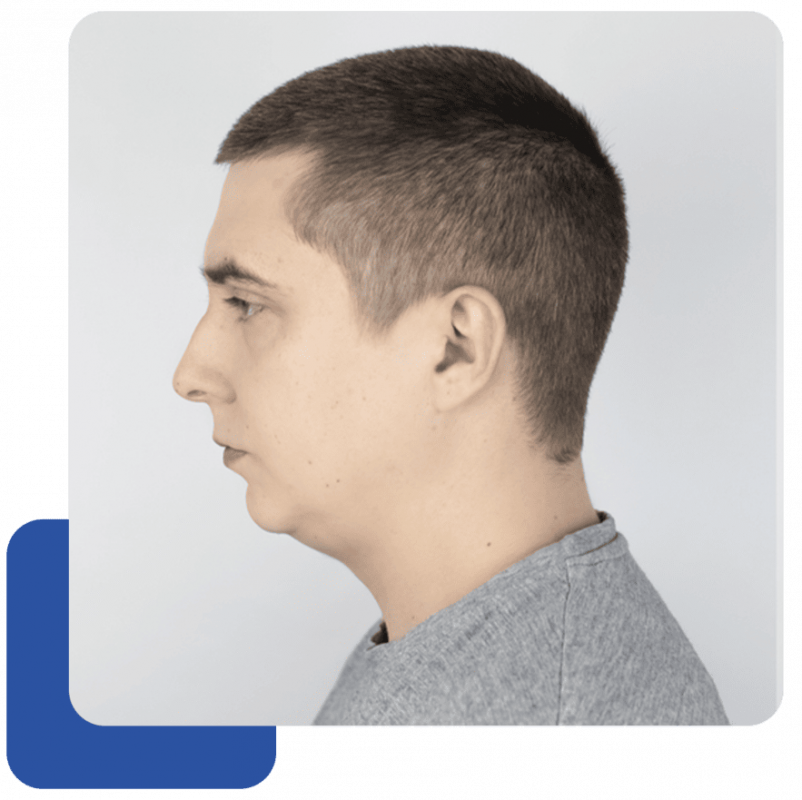 Previn dezvoltarea incorectă a maxilarului